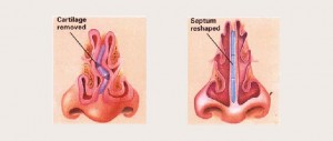 septoplasty-turbinate-reduction-procedures